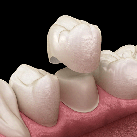 3D illustration Dental crowns in Arlington