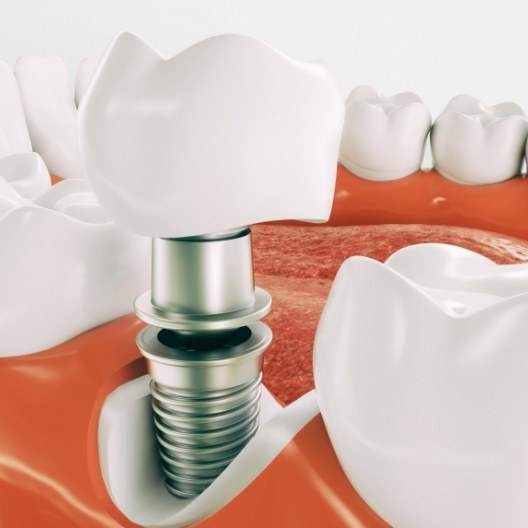 Animated parts of dental implant replacement tooth