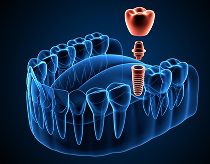 Example of dental implants in Arlington