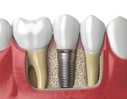 a 3D illustration of a dental implant in the jawbone